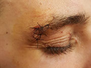 ceja suturada combate de boxeo